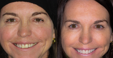 Ten porcelain veneers with gum contouring